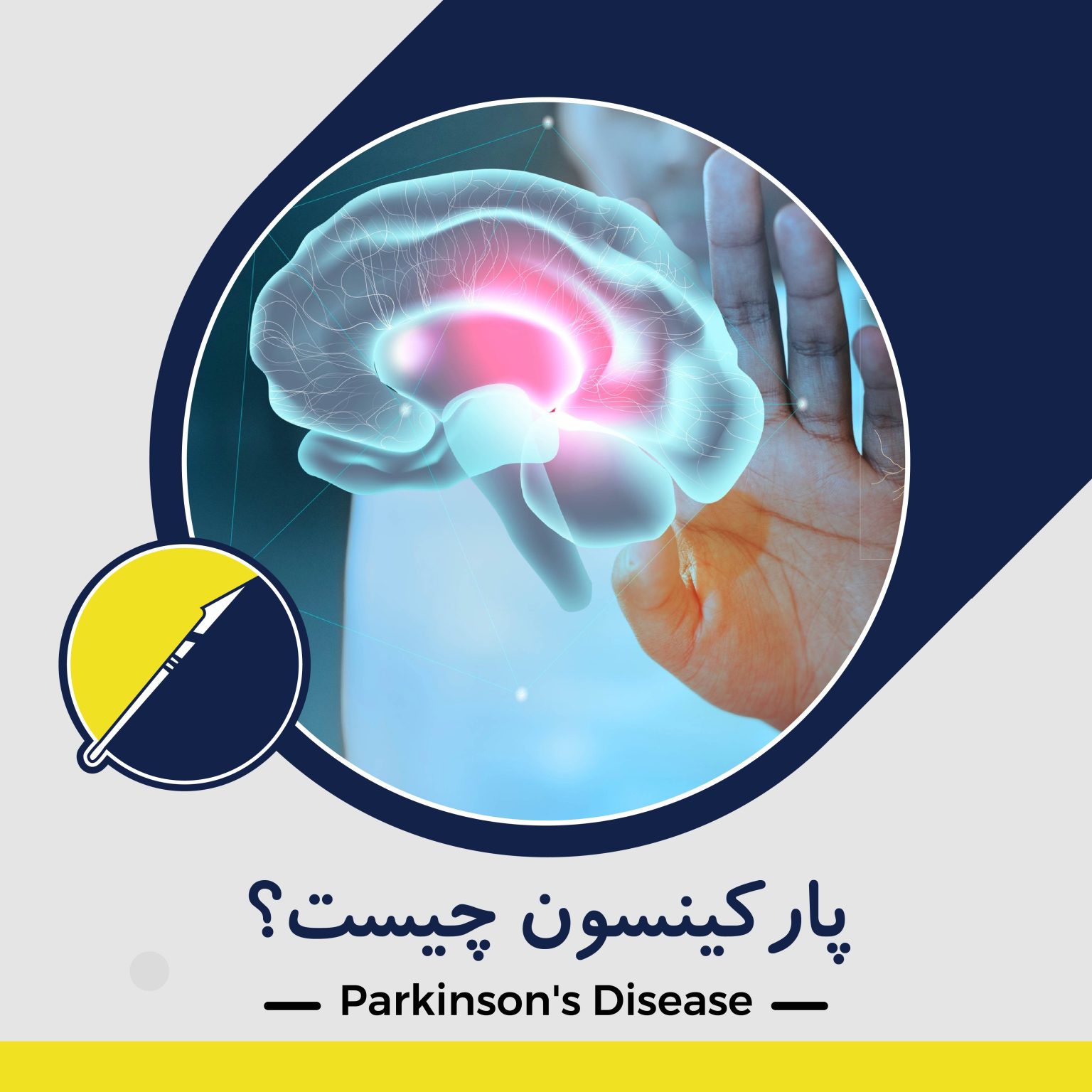 پارکینسون